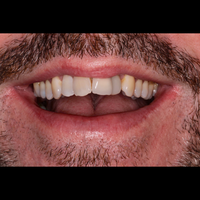 Crown and Veneer Smile - Dr. Feargal O'Connell before